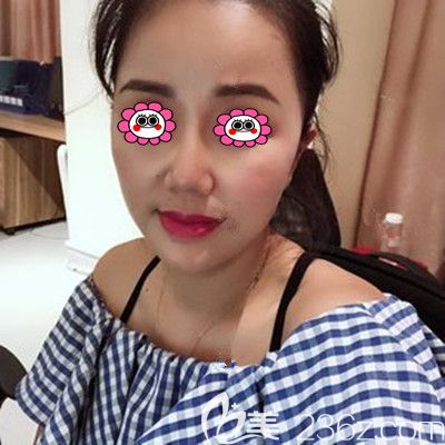 面部線雕后第二個(gè)月效果圖 面部線雕后第二個(gè)月效果圖