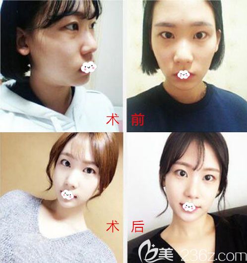 韓國麗珍吳銘俊面部輪廓整形案例前后效果對比圖