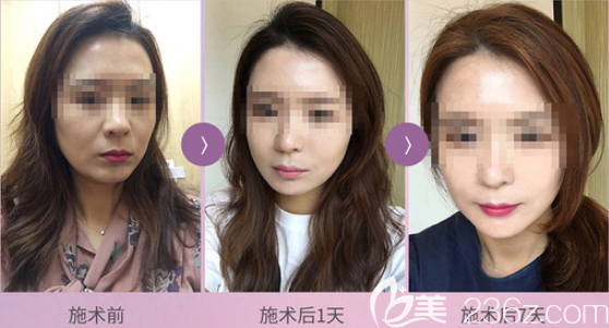 韓國麗珍埋線提升案例恢復(fù)過程