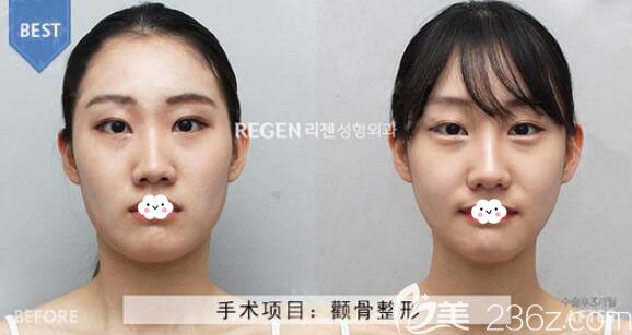 韓國麗珍顴骨內(nèi)推手術(shù)案例效果對比圖