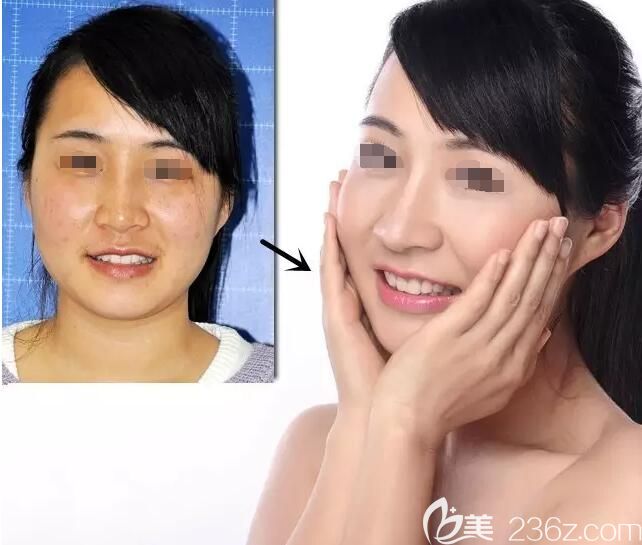 同事到無錫愛思特祛斑前后對比案例 同事到無錫愛思特祛斑前后對比案例