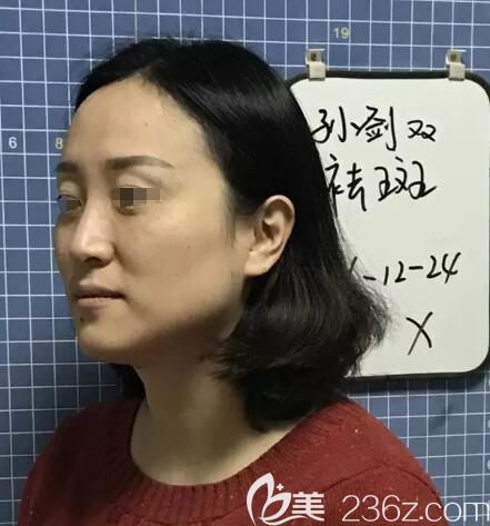 面診范紅梅醫(yī)生術(shù)前臉上斑點明顯 面診范紅梅醫(yī)生術(shù)前臉上斑點明顯