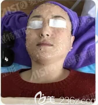 大Q祛斑術(shù)前面部涂抹麻醉膏 大Q祛斑術(shù)前面部涂抹麻醉膏