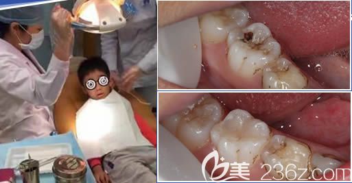 廣州圣貝口腔楊妙芬齲齒填充效果對比圖 廣州圣貝口腔楊妙芬齲齒填充效果對比圖