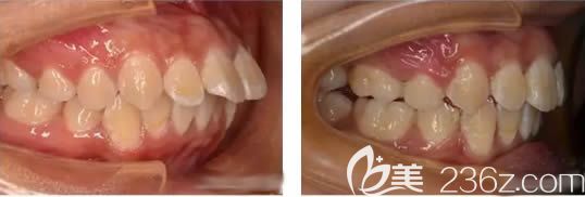 福州維樂口腔郭院長成人齙牙矯正前后對比照 福州維樂口腔郭院長成人齙牙矯正前后對比照