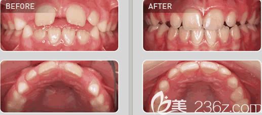 福州維樂郭淑蘋醫(yī)生mrc肌功能矯正前后對比效果 福州維樂郭淑蘋醫(yī)生mrc肌功能矯正前后對比效果