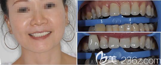 廣州圣貝口腔楊妙芬冷光美白效果對比圖 廣州圣貝口腔楊妙芬冷光美白效果對比圖