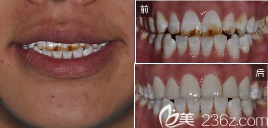 廣州圣貝口腔趙艷明牙齒貼面效果對(duì)比 廣州圣貝口腔趙艷明牙齒貼面效果對(duì)比