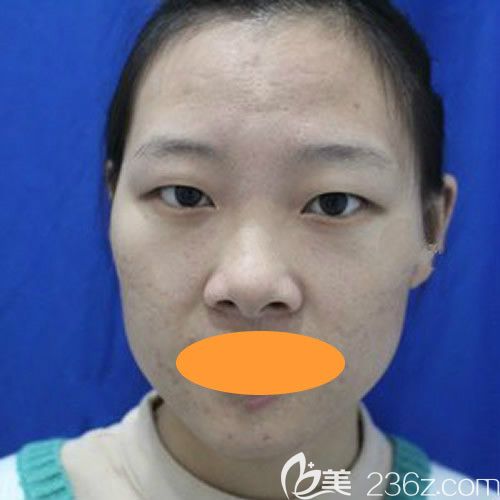 2年前做的埋線雙眼皮消失后的樣子 2年前做的埋線雙眼皮消失后的樣子