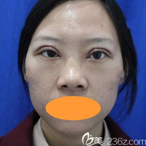 西寧時光醫(yī)院薛院長給我做全切7mm雙眼皮術(shù)后第1天 西寧時光醫(yī)院薛院長給我做全切7mm雙眼皮術(shù)后第1天