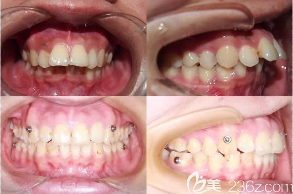 廈門登特口腔袁煒靈醫(yī)師隱形正畸效果對比圖