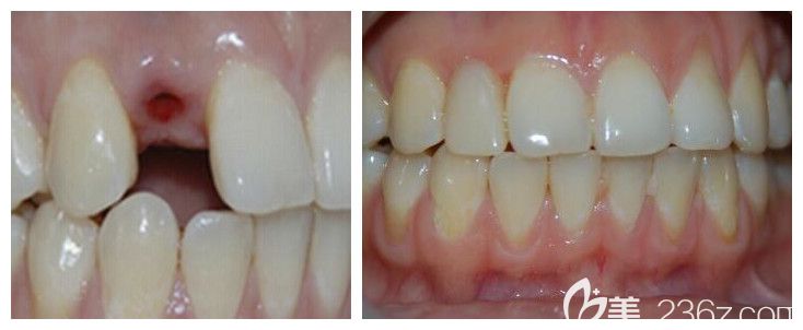 徐雅軒醫(yī)生單顆牙種植案例 徐雅軒醫(yī)生單顆牙種植案例