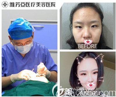 石家莊雅芳亞4月春季整形進(jìn)行時(shí) 激光祛斑和雙眼皮的優(yōu)惠價(jià)格為1980元