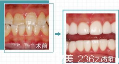 福州維樂口腔醫(yī)院林錦醫(yī)生牙齒美白案例 福州維樂口腔醫(yī)院林錦醫(yī)生牙齒美白案例