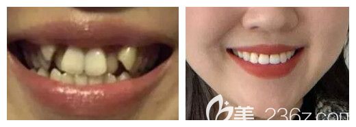 鄭州拜博口腔馬賀博士正畸案例 鄭州拜博口腔馬賀博士正畸案例