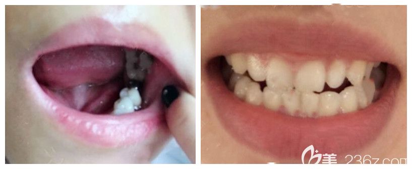 鄭州拜博口腔張立釗主任單顆種植牙效果圖