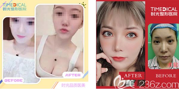 蘭州時(shí)光賈志蘭假體隆胸+雙眼皮失敗修復(fù)效果怎么樣