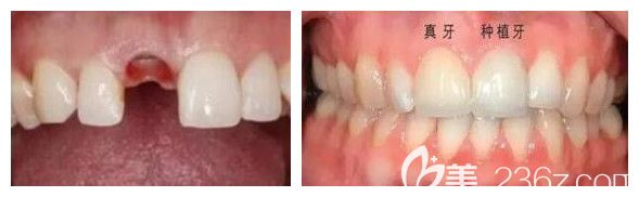 鄭州拜博口腔王中杰主任前牙種植效果 鄭州拜博口腔王中杰主任前牙種植效果