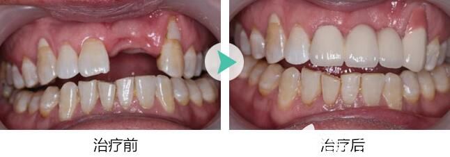 鄭州拜博口腔王咲予院長單顆種植牙效果圖 鄭州拜博口腔王咲予院長單顆種植牙效果圖