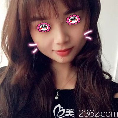 閨蜜陪我到常德伊麗莎白做面部脂肪填充三個(gè)月后，決定找盧開(kāi)銳做雙眼皮