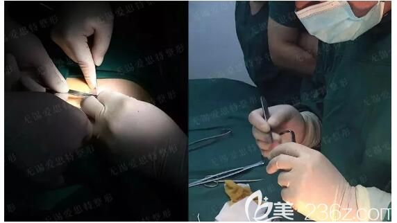 無錫愛思特醫(yī)生做鼻綜合整形中 無錫愛思特醫(yī)生做鼻綜合整形中