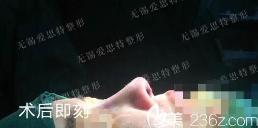 做了鼻綜合術后即刻郭曄醫(yī)生分享鼻子效果 做了鼻綜合術后即刻郭曄醫(yī)生分享鼻子效果