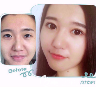 榆林博愛雙眼皮整形案例一