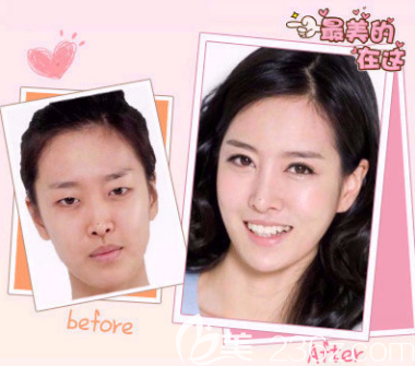 榆林博愛雙眼皮案例2