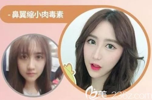 韓國(guó)繆慈瘦臉除皺縮小鼻翼案例 韓國(guó)繆慈瘦臉除皺縮小鼻翼案例