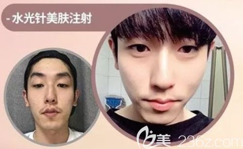 韓國(guó)繆慈注射美膚案例 韓國(guó)繆慈注射美膚案例