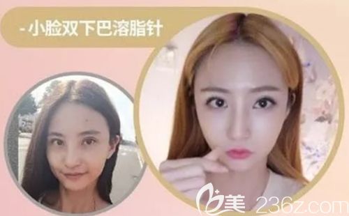 韓國(guó)繆慈雙下巴溶脂案例 韓國(guó)繆慈雙下巴溶脂案例