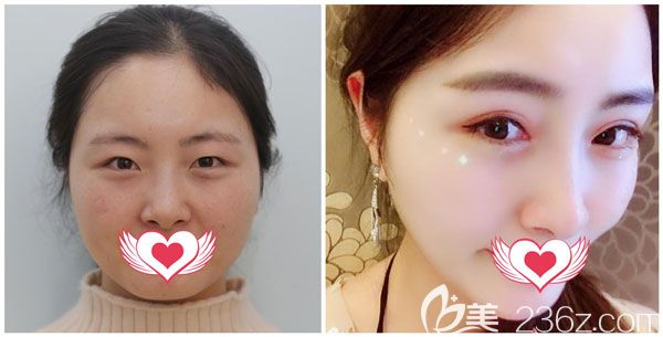 金輝做全切雙眼皮+開眼角案例效果