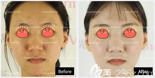 嘉興曙光玻尿酸填充<span style=