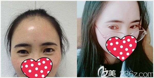 西寧時光整形薛院長全切7mm雙眼皮一個月恢復效果圖 西寧時光整形薛院長全切7mm雙眼皮一個月恢復效果圖