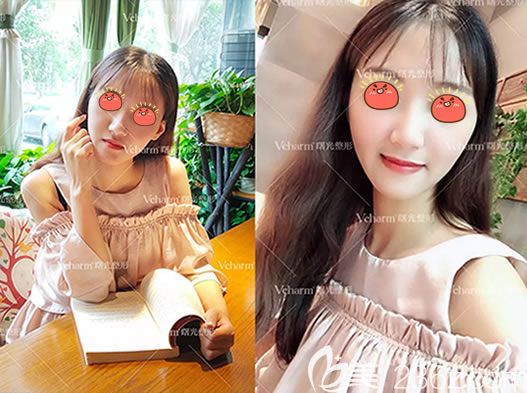 我就想微微整一下,于是我選擇嘉興曙光注射喬雅登玻尿酸進(jìn)行面部填充提升