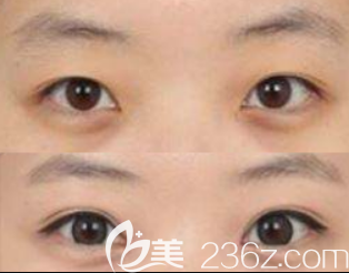 韓國BBC成政燁院長雙眼皮案例效果對(duì)比圖