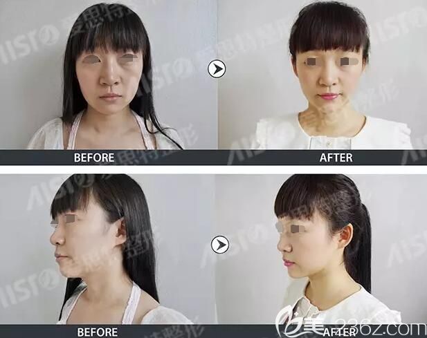 玻尿酸+線拉提升術(shù)改善面部凹陷，提拉下垂面部組織