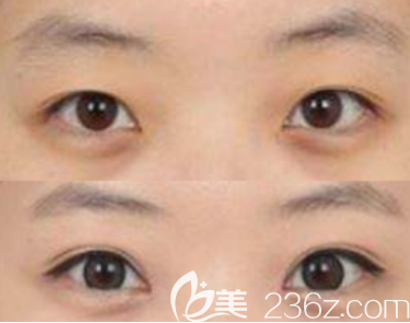 韓國BBC整形外科醫(yī)院雙眼皮真人案例 韓國BBC整形外科醫(yī)院雙眼皮真人案例