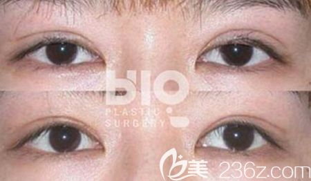 辛容鎬眼睛修復的怎樣？看看他的雙眼皮修復案例你就知道了