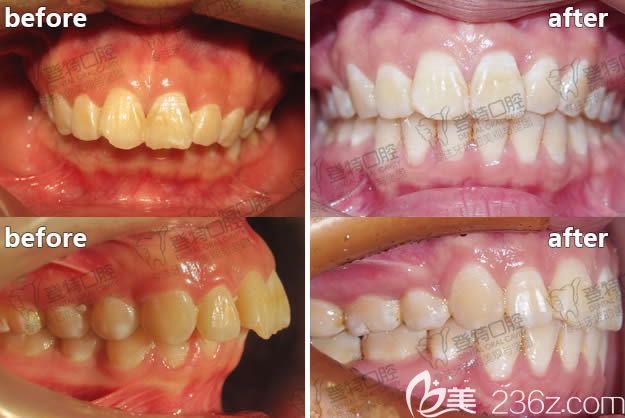 廈門(mén)登特口腔南詳明深覆合案例正畸效果對(duì)比圖 廈門(mén)登特口腔南詳明深覆合案例正畸效果對(duì)比圖