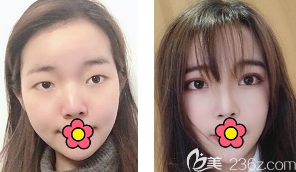 蘭州韓美呂娟霞真人全切雙眼皮+自體脂肪面部填充前后效果對比案例 蘭州韓美呂娟霞真人全切雙眼皮+自體脂肪面部填充前后效果對比案例