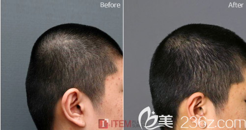 韓國(guó)愛(ài)婷骨水泥填充后腦勺案例效果對(duì)比圖