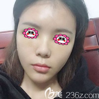 全臉脂肪填充一周后