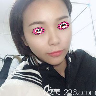 全臉脂肪填充第3個月圖片