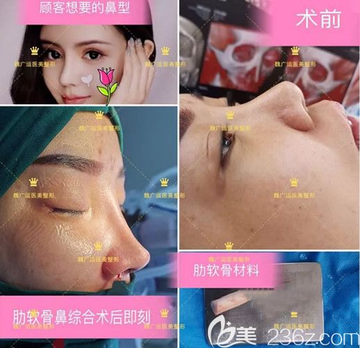 做鼻子怎么樣 他在蘭州韓美整形坐診時(shí)自體肋軟骨鼻綜合隆鼻+割雙眼皮案例展示啦
