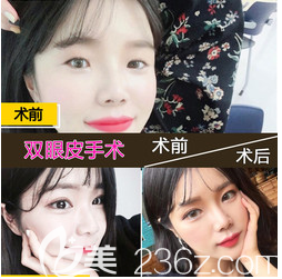 深圳德漾陳群院長隆鼻案例圖 深圳德漾陳群院長隆鼻案例圖