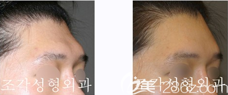 韓國(guó)雕刻整形醫(yī)院骨水泥填充額頭案例效果對(duì)比圖