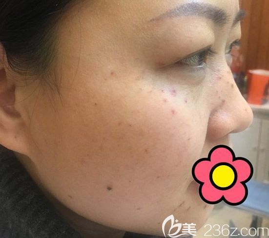 皮秒激光祛斑第五天圖片 皮秒激光祛斑第五天圖片