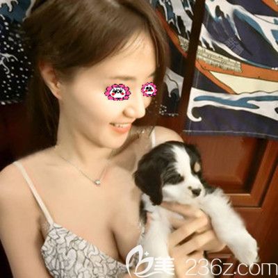 做過自體脂肪豐胸的我，第二次選擇在整形做275cc的假體隆胸