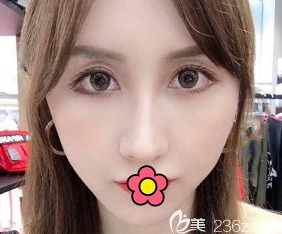 有人說埋線提升后悔死了 但我找蘭州韓美呂娟霞做面部逆齡線雕效果就很好